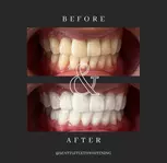 Up to 40% Off on Teeth Whitening at Seattle Teeth Whitening