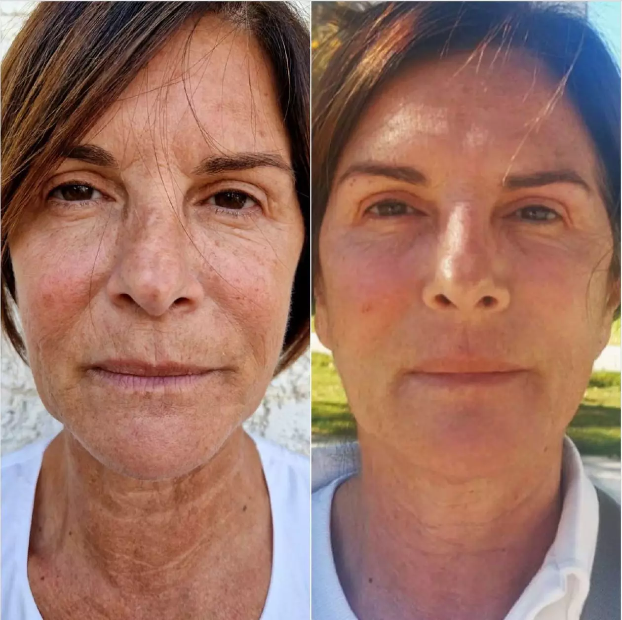 Up to 50% Off on Laser Skin Resurfacing - Branded at H.S. Medical Aesthetics & Wellness Center