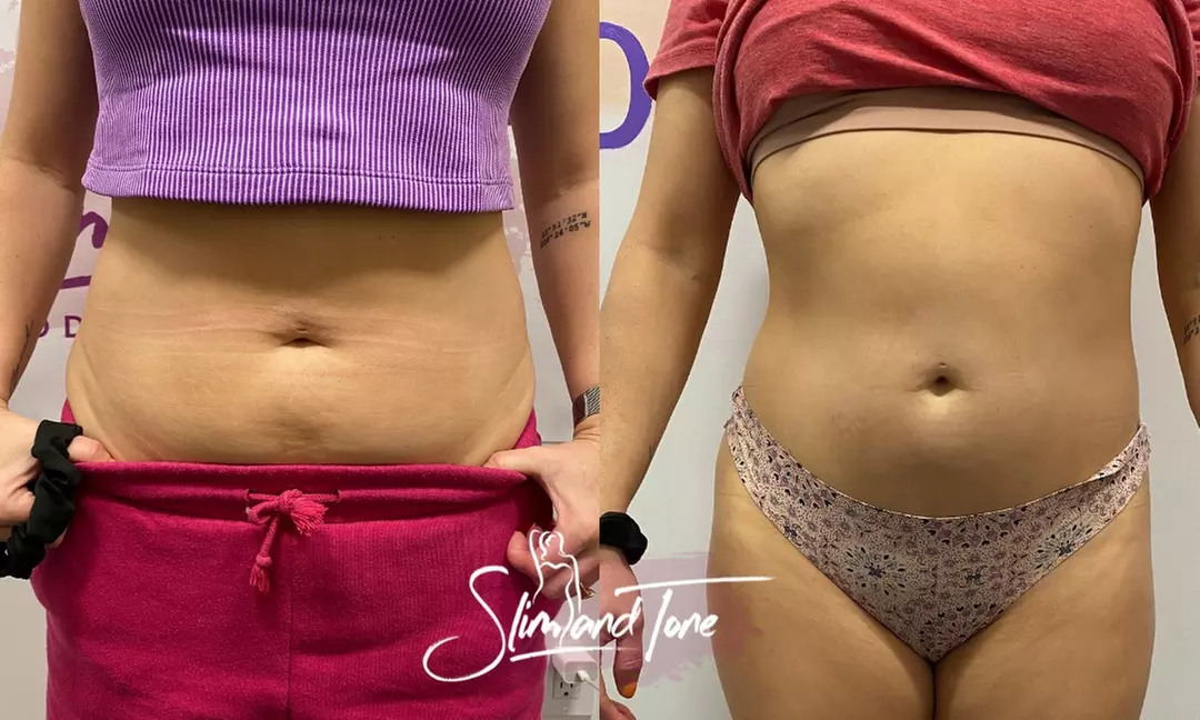 EMSculpt Sessions: Tone Muscles and Target Fat in 30 Minutes
