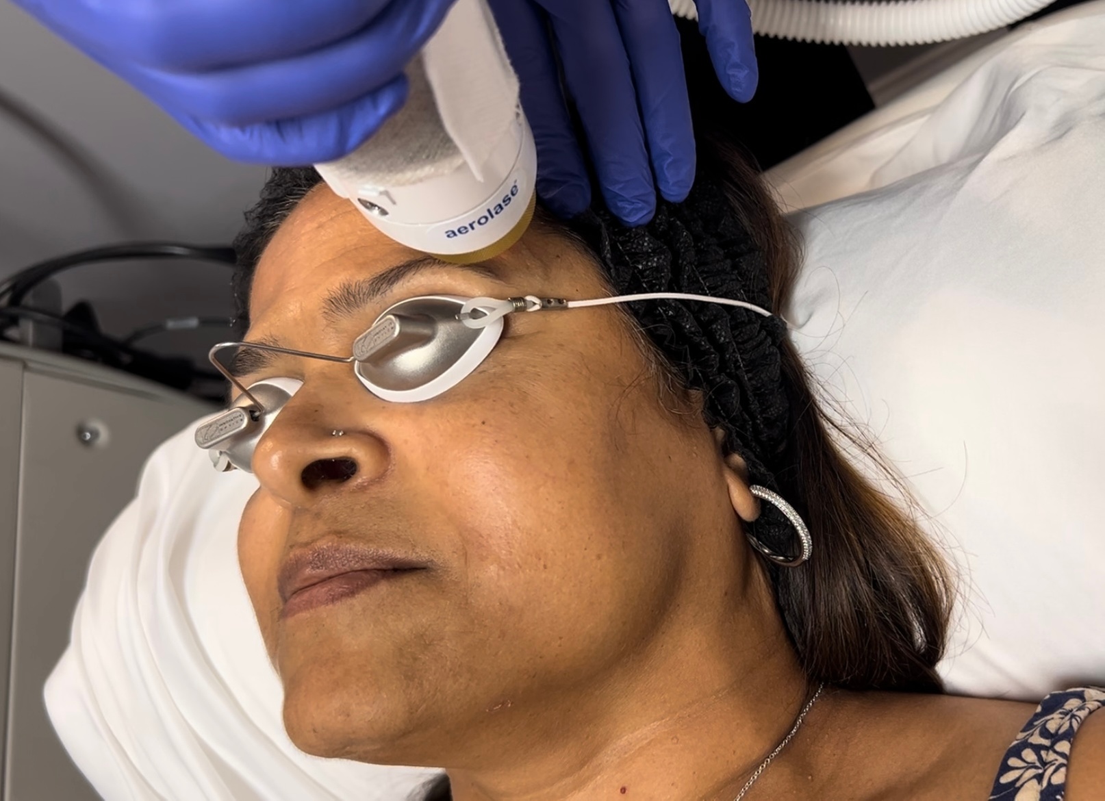 Refresh your skin with Aerolase laser acne treatment sessions