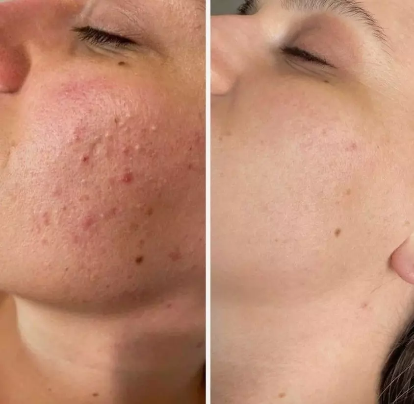 Up to 55% Off on Laser Skin Resurfacing - Branded at Aesthetics Care Med Spa