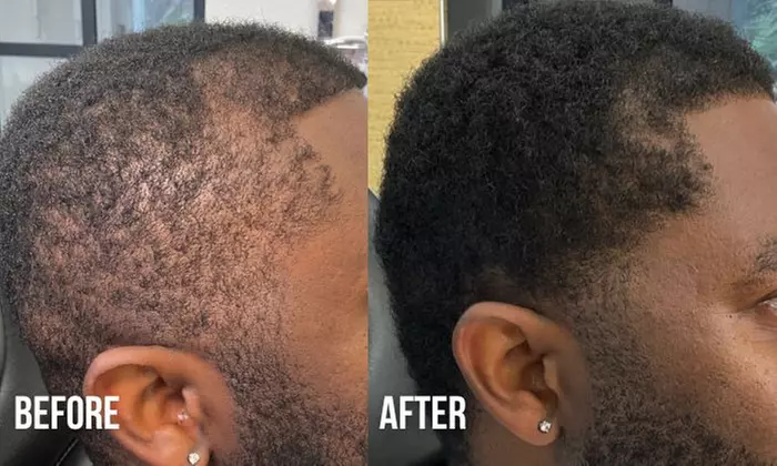 Up to 67% Off on Hair Restoration - Non-Surgical at Nude Aesthetics