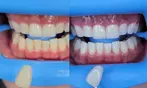 Up to 46% Off on Teeth Whitening at Vs Aesthetics