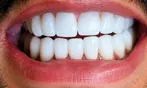 Up to 89% Off on Teeth Whitening - In-Office - Branded (Beyond, Power) at Your Covina Family Dentistry