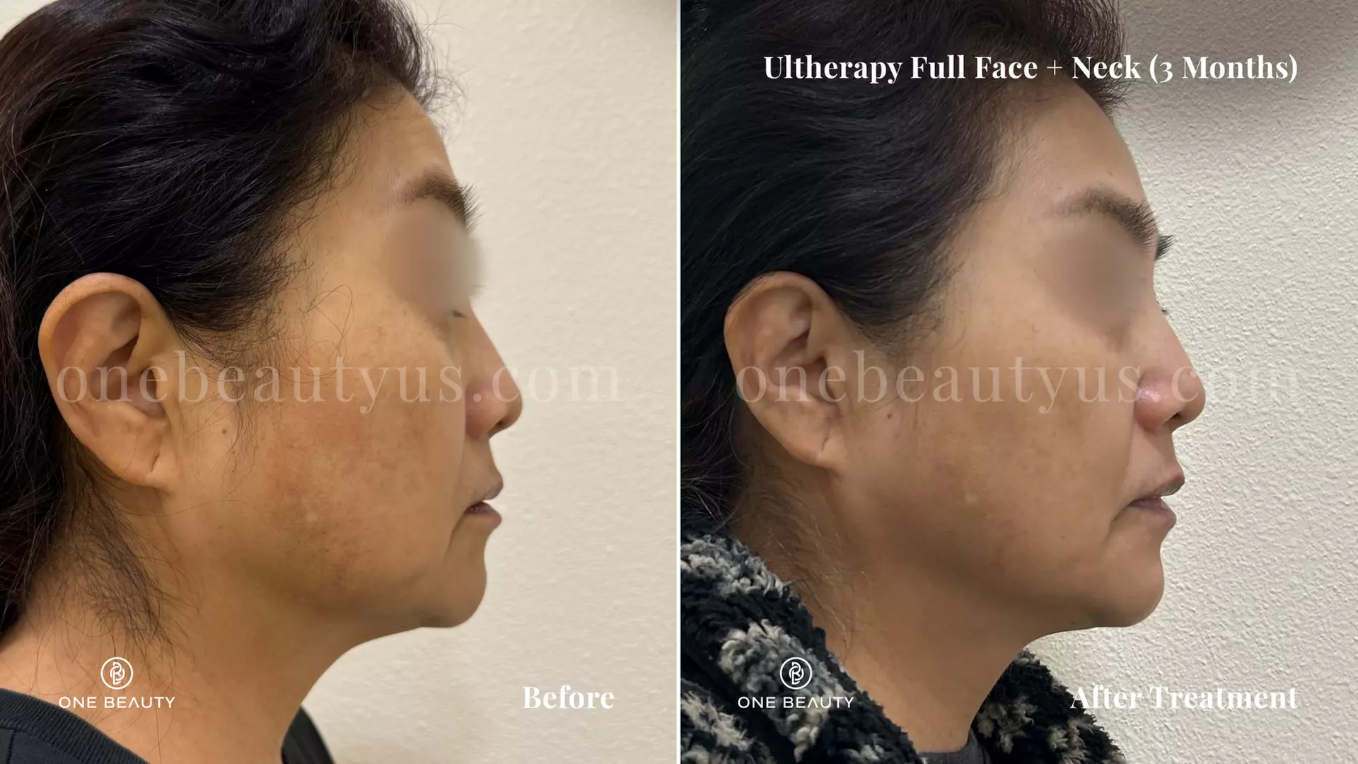 Ultherapy / Ultrasonic Facial at One Beauty Aesthetics