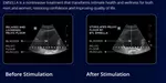 1 or 3 High Intensity Focused Electromagnetic Incontinence Treatments