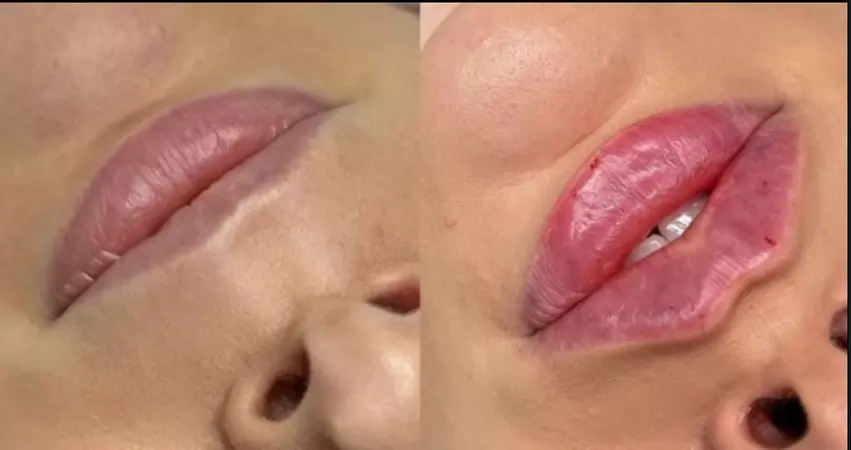 Up to 30% Off on Injection - Dermal Filler at No Pain All Gain Spa