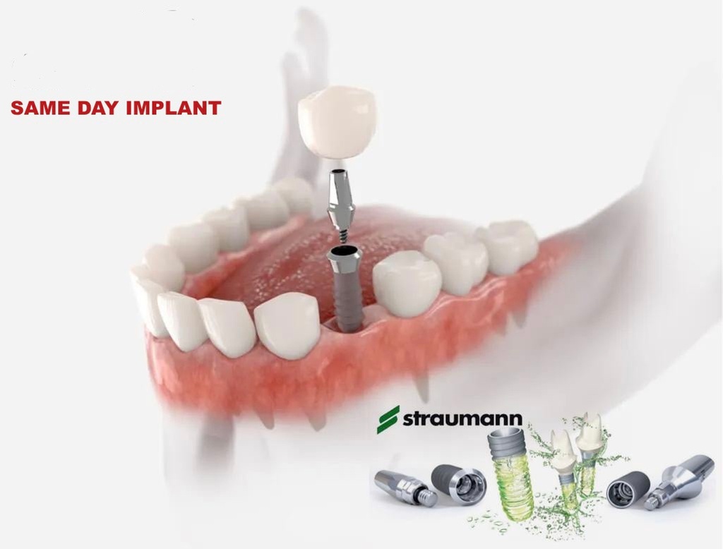 Dental Implant—including Bone Graft, Implant, and Abutment Crown at Smile Dental Care—55% Off
