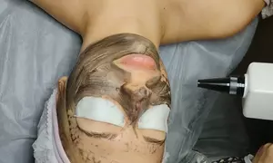 Laserowy peeling węglowy twarzy z opcjonalną ampułką i maską algową w Gabinecie Ingeniumm Termy Maltańskie