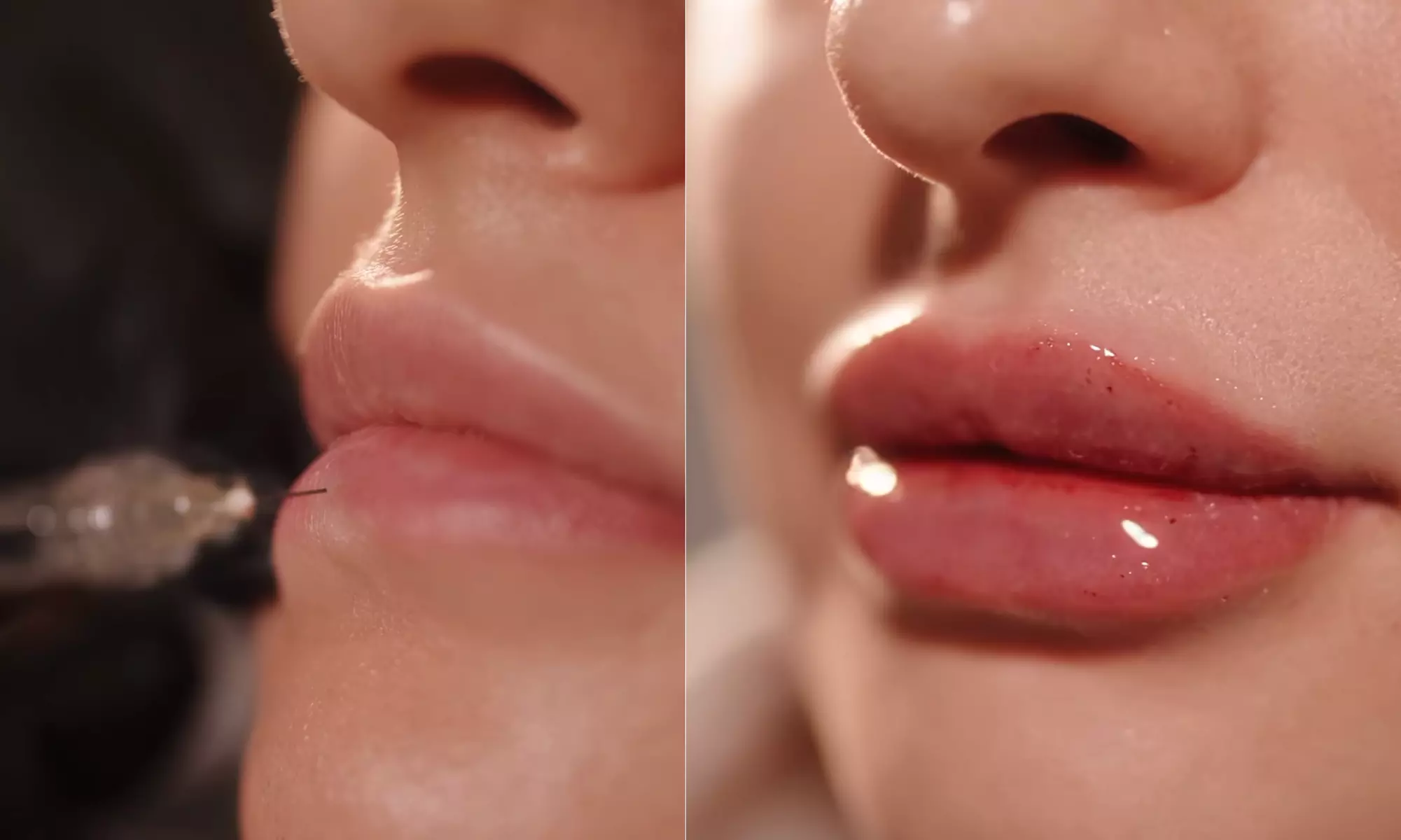 Up to 38% Off on Injection - Dermal Filler at Nova Luna Wellness