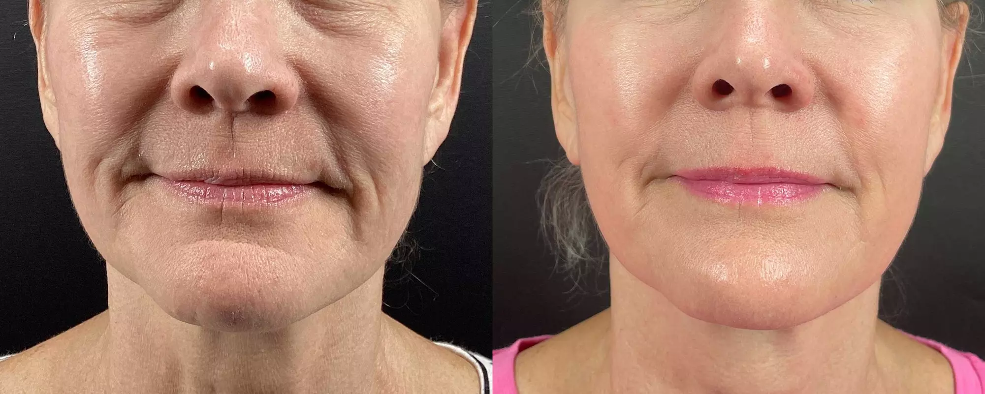 Radiant Skin Awaits: Transform with Morpheus8 RF Technology!