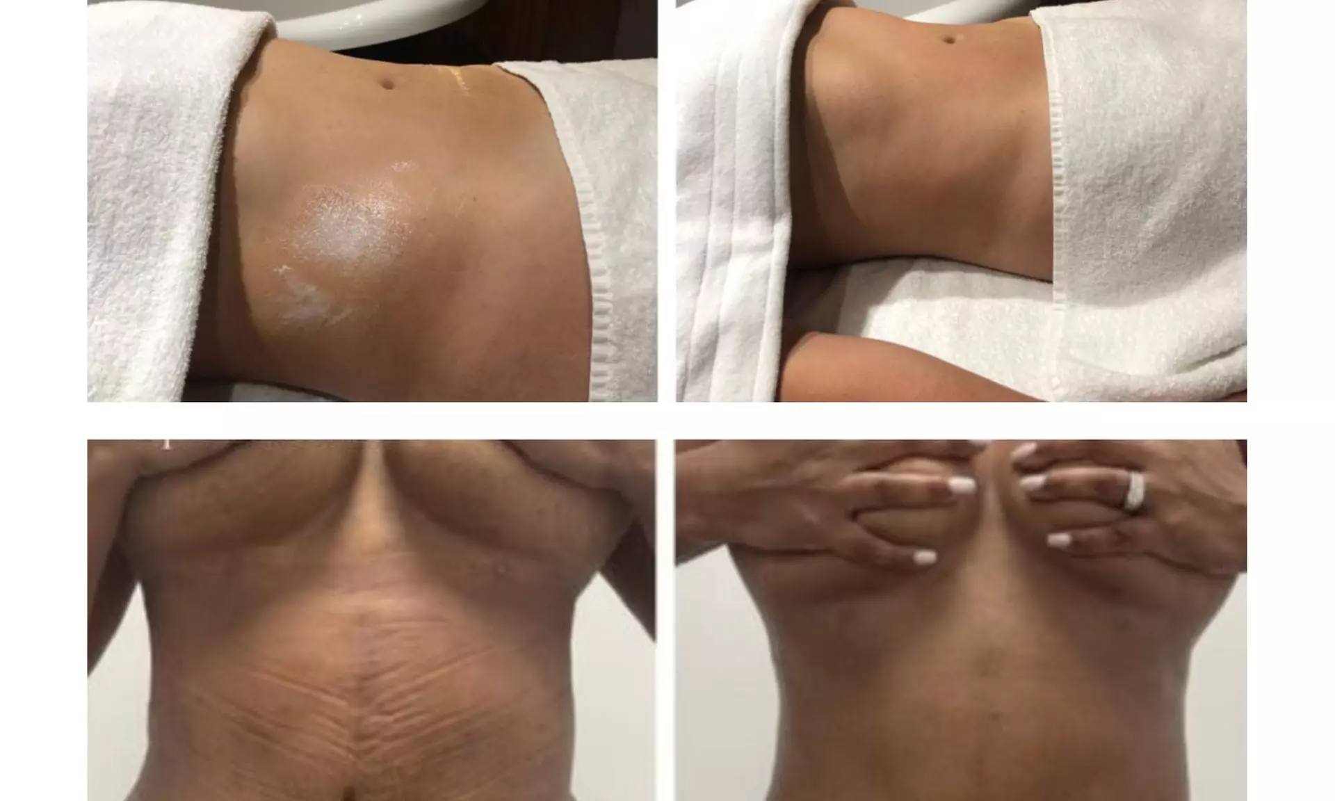 Get Laser Lipo, Fat Dissolving Shots, Lymphatic Drainage Massage!