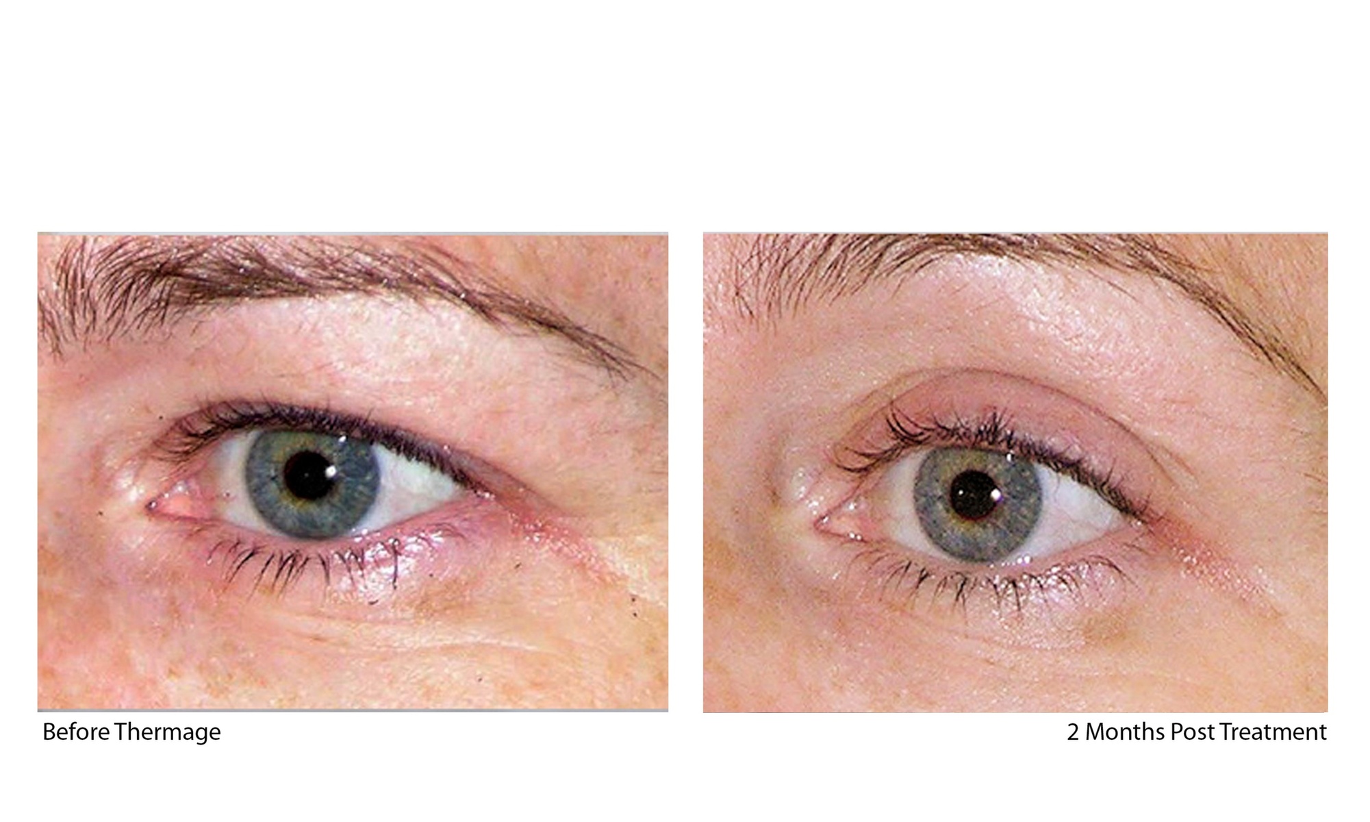 Experience Rewind Advanced Aesthetics' Skin Tightening for Stomach, Eyes, Neck, or Knees (Up to 40% Off)