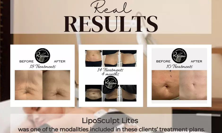 Choose from Two, Four, or Six Lipo Sculpt Lite Sessions