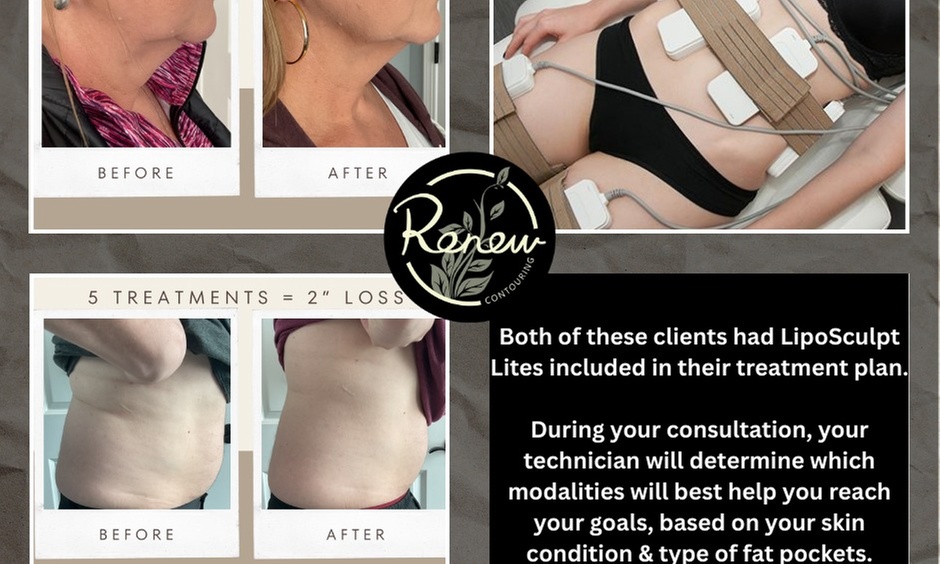 Choose from Two, Four, or Six Lipo Sculpt Lite Sessions