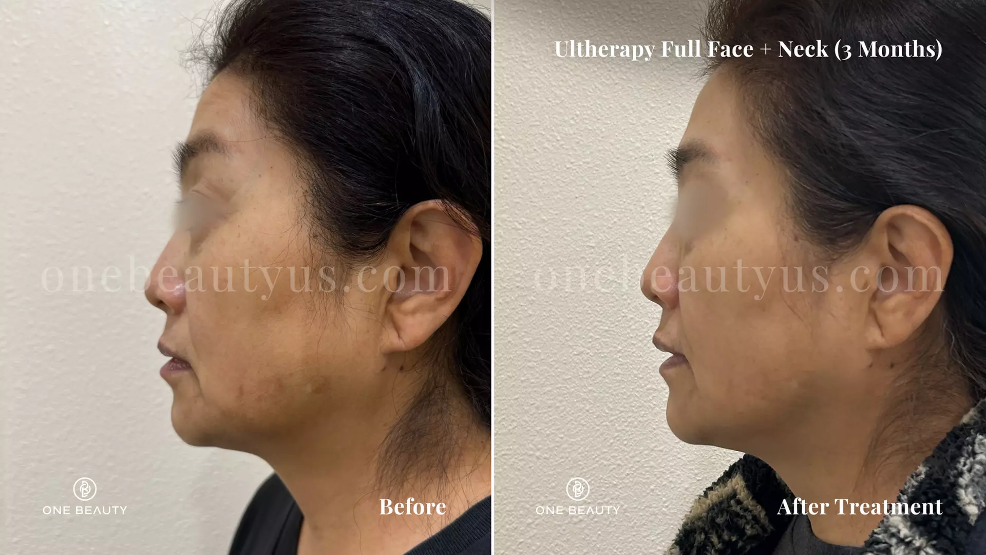 Ultherapy / Ultrasonic Facial at One Beauty Aesthetics