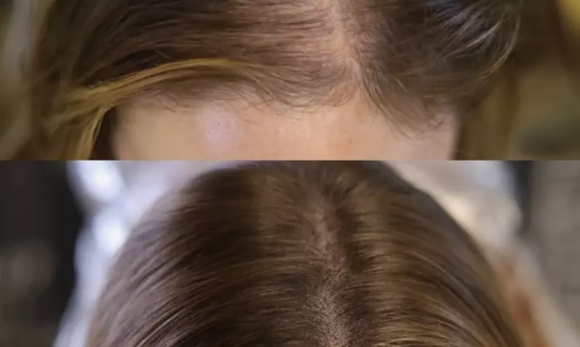 Areola Tattoo Treatment, Scalp Micropigmentation Or Cheek Blush Tattoo