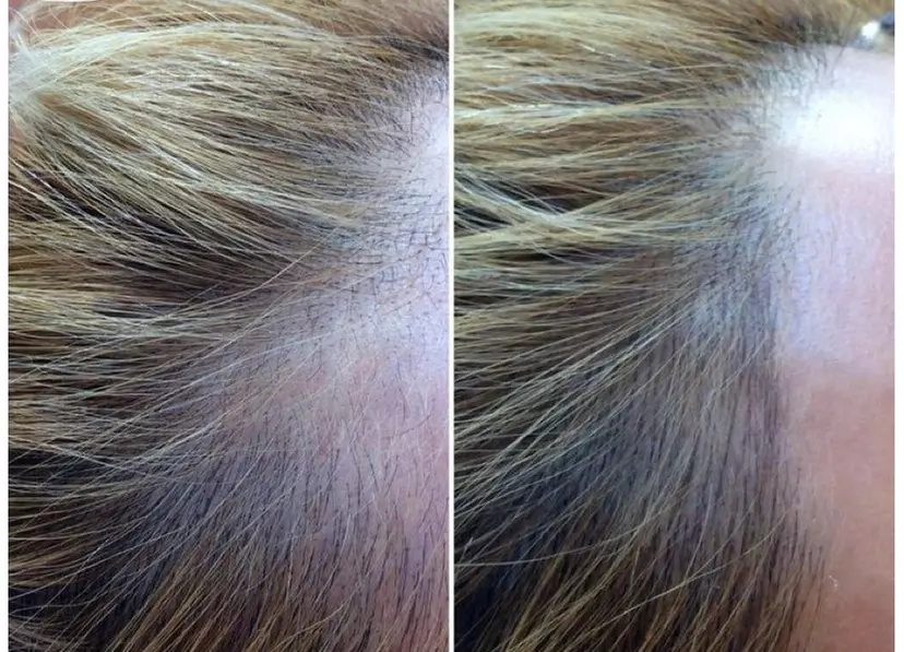 Areola Tattoo Treatment, Scalp Micropigmentation Or Cheek Blush Tattoo