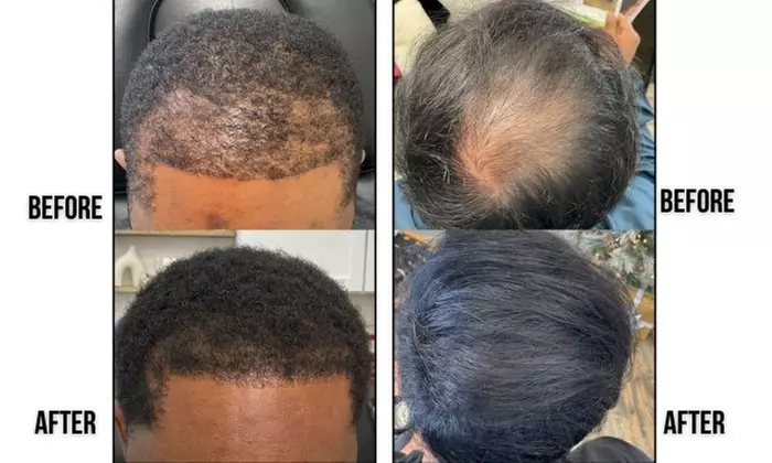 Up to 67% Off on Hair Restoration - Non-Surgical at Nude Aesthetics