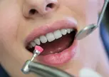 Crown Whitening & Optional Cleaning at Green Dental (Up to 52% Off)
