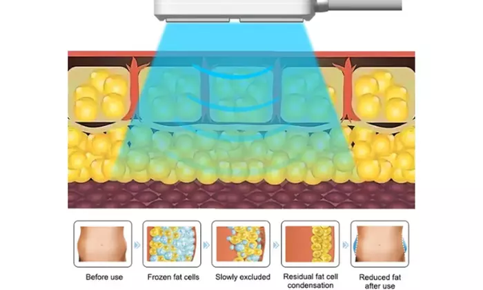 Achieve Body Contouring With 4 or 8 Paddle Cryolipolysis