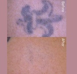Say Goodbye To Unwanted Tattoo: Laser Tattoo Removal Session