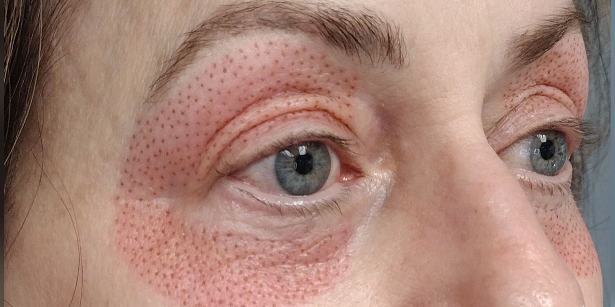 Non-surgical facelift: lip flip and eyelid lift options available