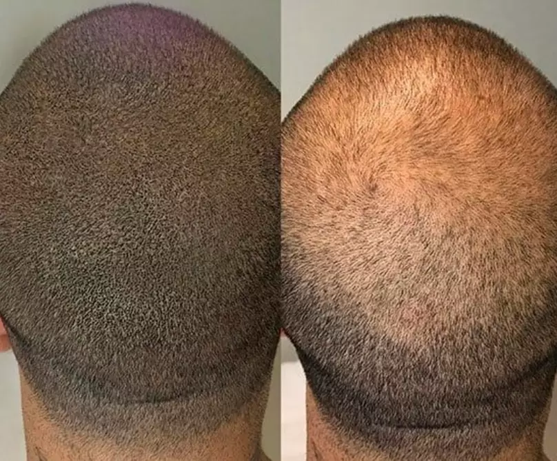 Areola Tattoo Treatment, Scalp Micropigmentation Or Cheek Blush Tattoo