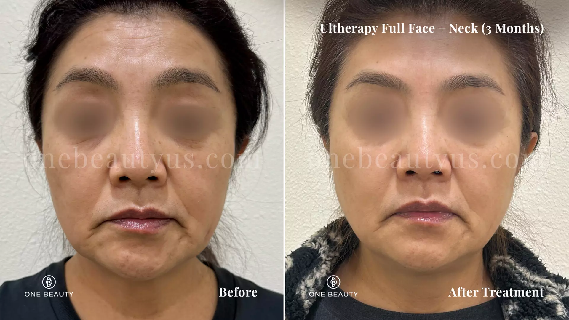 Ultherapy / Ultrasonic Facial at One Beauty Aesthetics