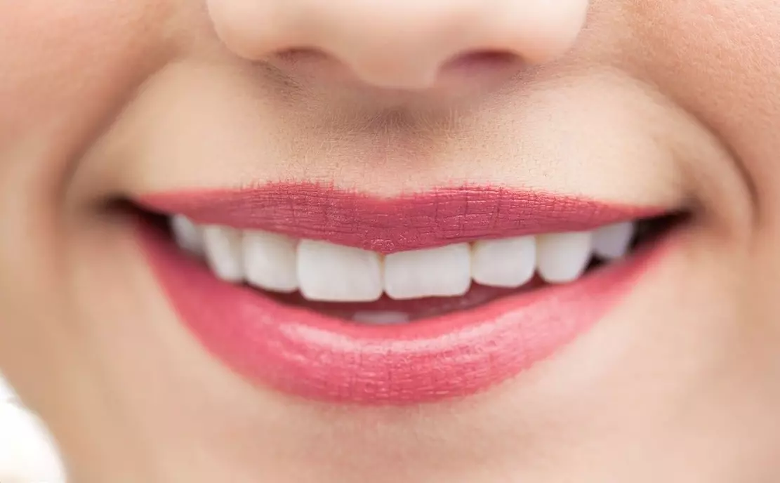 1 oder 2 Kosmetische Zahnbleachings à 30 Min. für 1 Person