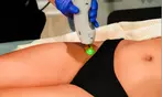 Up to 61% Off on Laser Hair Removal at InSkin Laser Aesthetics
