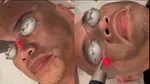 Pico Laser Carbon Peel with Complimentary Facial Cleaning