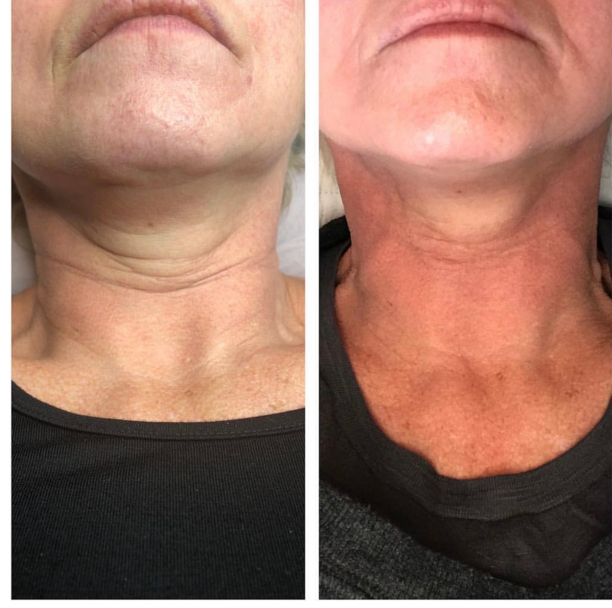 Up to 50% Off on Laser Skin Resurfacing-Unbranded at Wicked aesthetics