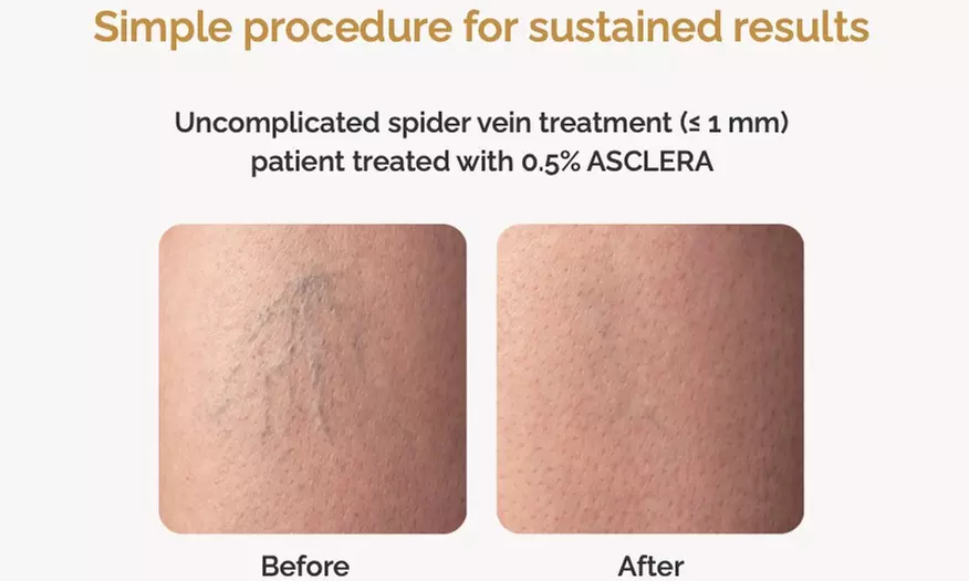 One or Two: Spider Vein Treatments with Complimentary Consultation