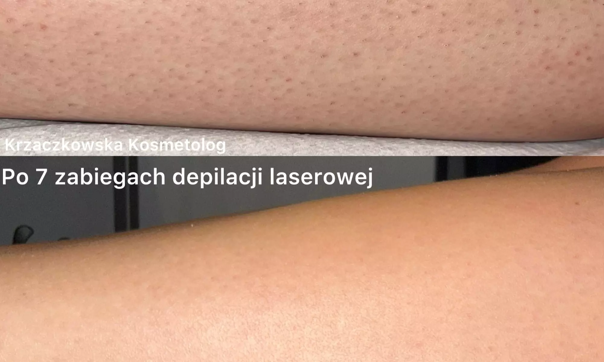 Zabieg depilacji laserowej na małą lub średnią partię ciała