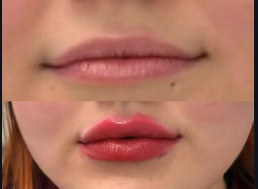 Up to 30% Off on Injection - Dermal Filler at No Pain All Gain Spa