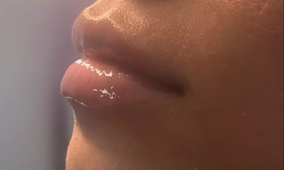 Up to 43% Off on Lip Enhancement at AB Botox Queen
