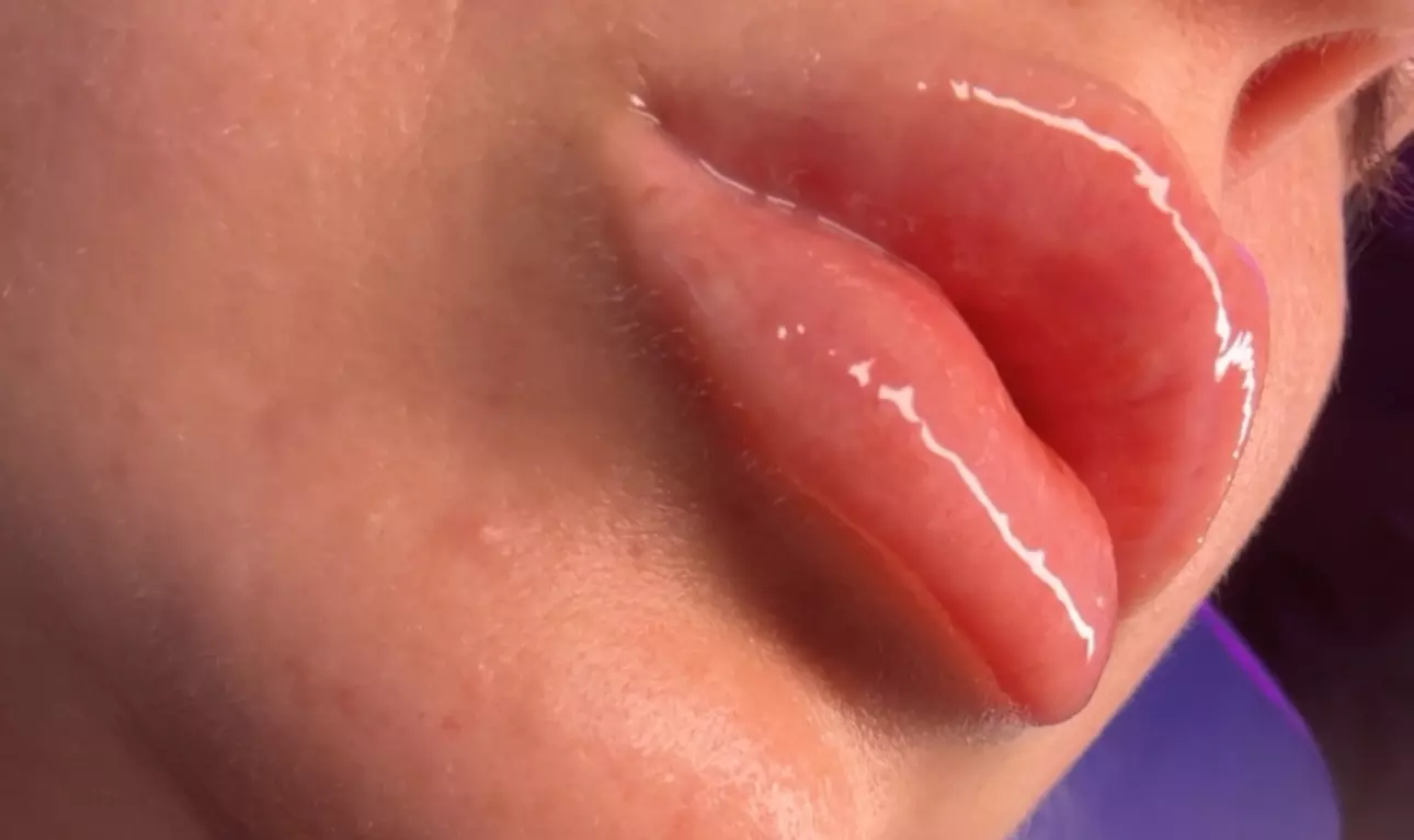 Up to 43% Off on Lip Enhancement at AB Botox Queen