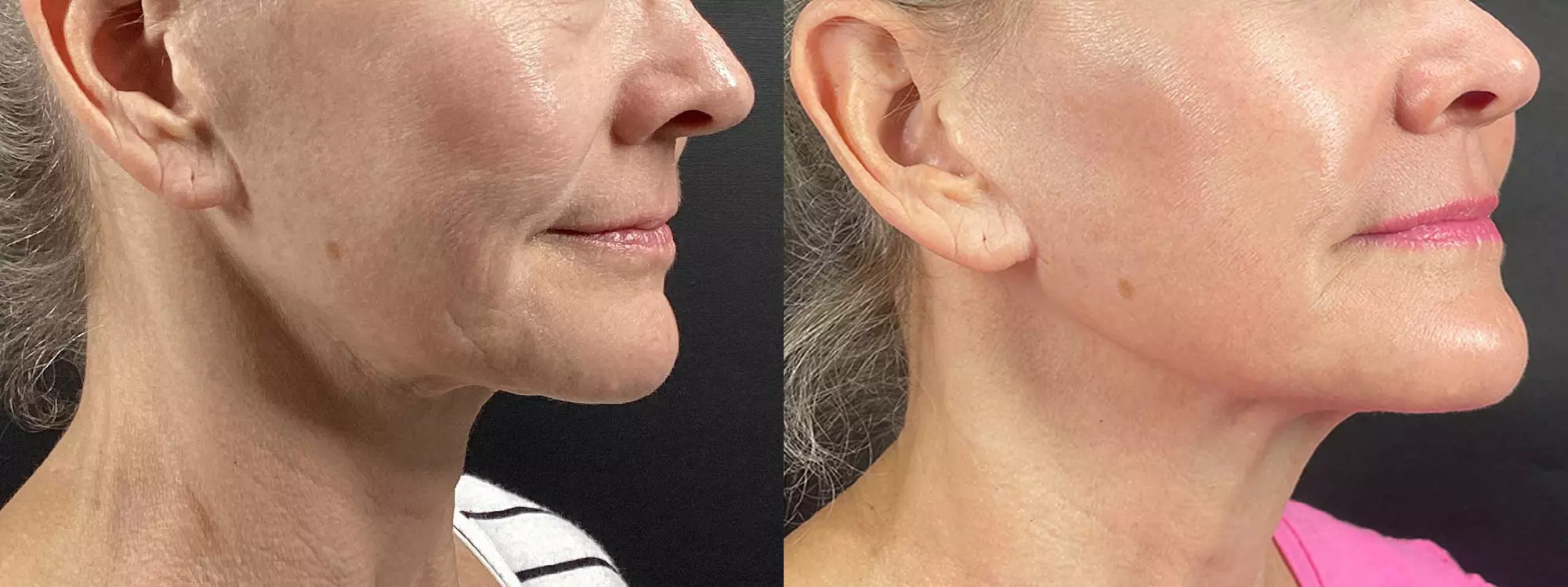 Radiant Skin Awaits: Transform with Morpheus8 RF Technology!