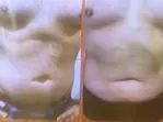 Transform Your Body with Two or Four Laser Liposuction Sessions