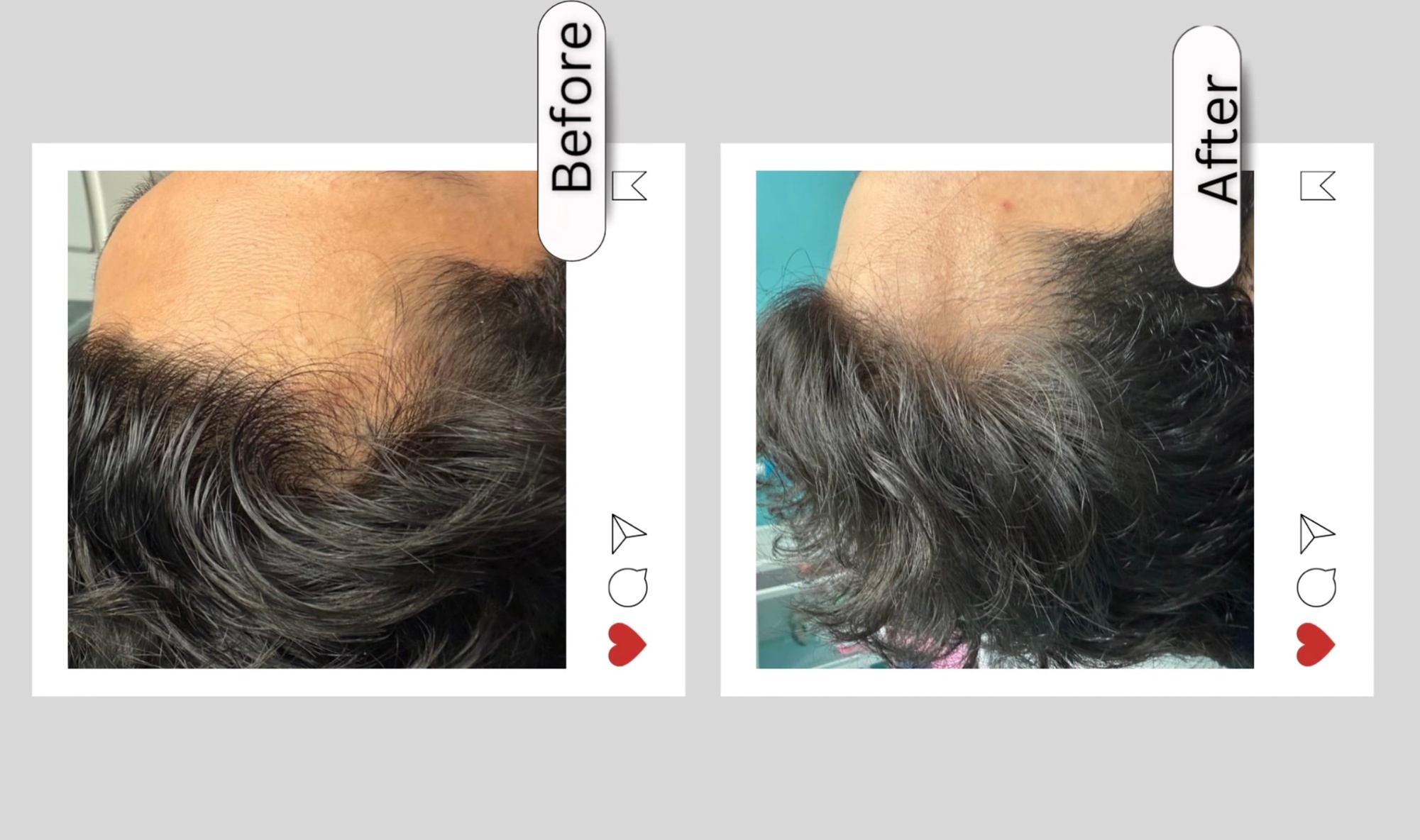 Up to 55% Off on Hair Restoration - Non-Surgical at Aesthetics Care Med Spa