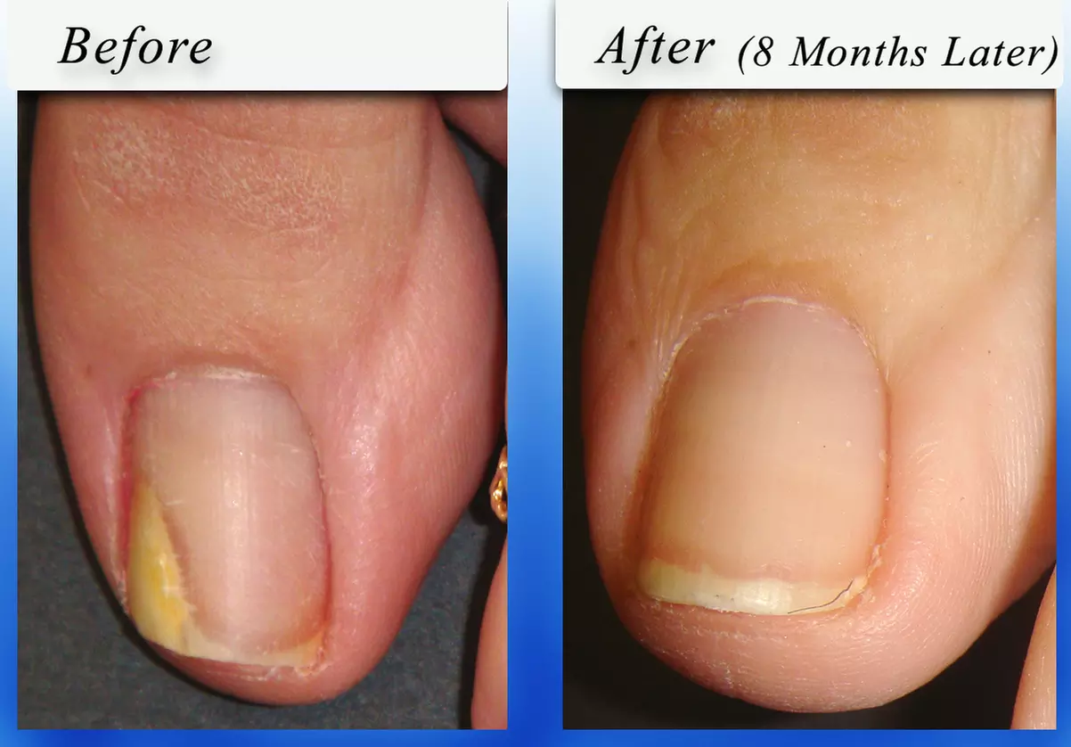 Medical Pedicure, Callus Reduction or Nail Fungus Consultation