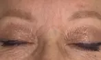 Achieve Ink-Free Skin with Laser by Nicole's Tattoo Removal for All Sizes up to 39%