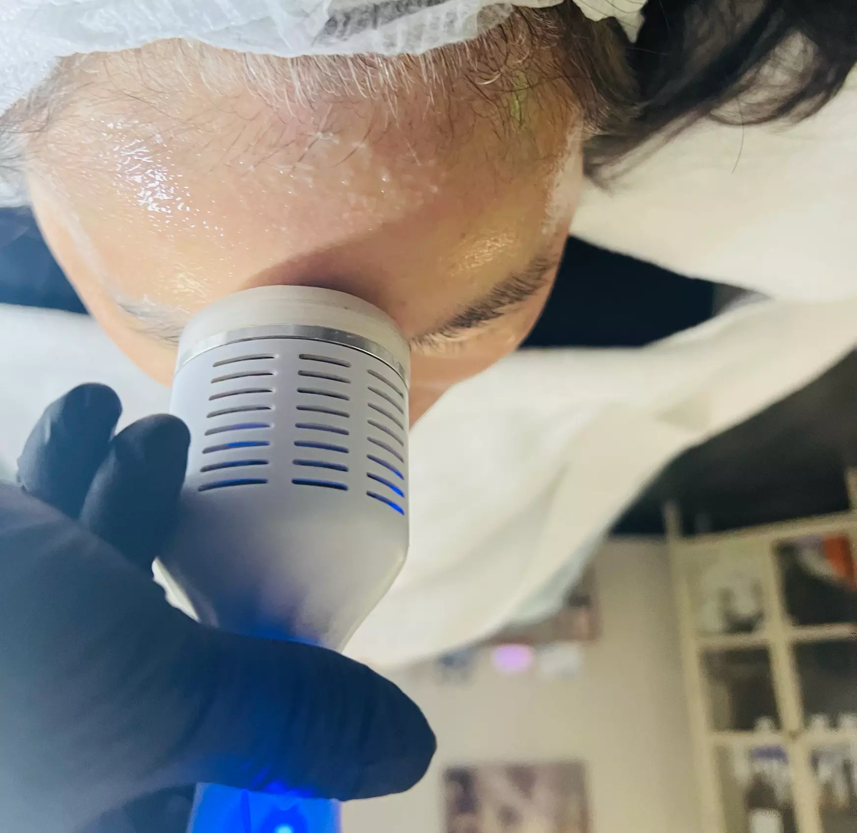 Transform Your Skin: Microneedling with Cryo & Glutathione