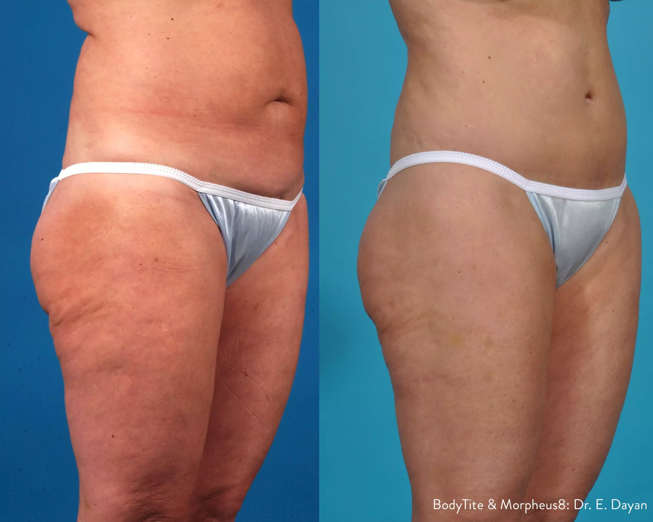 Radiant Skin Awaits: Transform with Morpheus8 RF Technology!