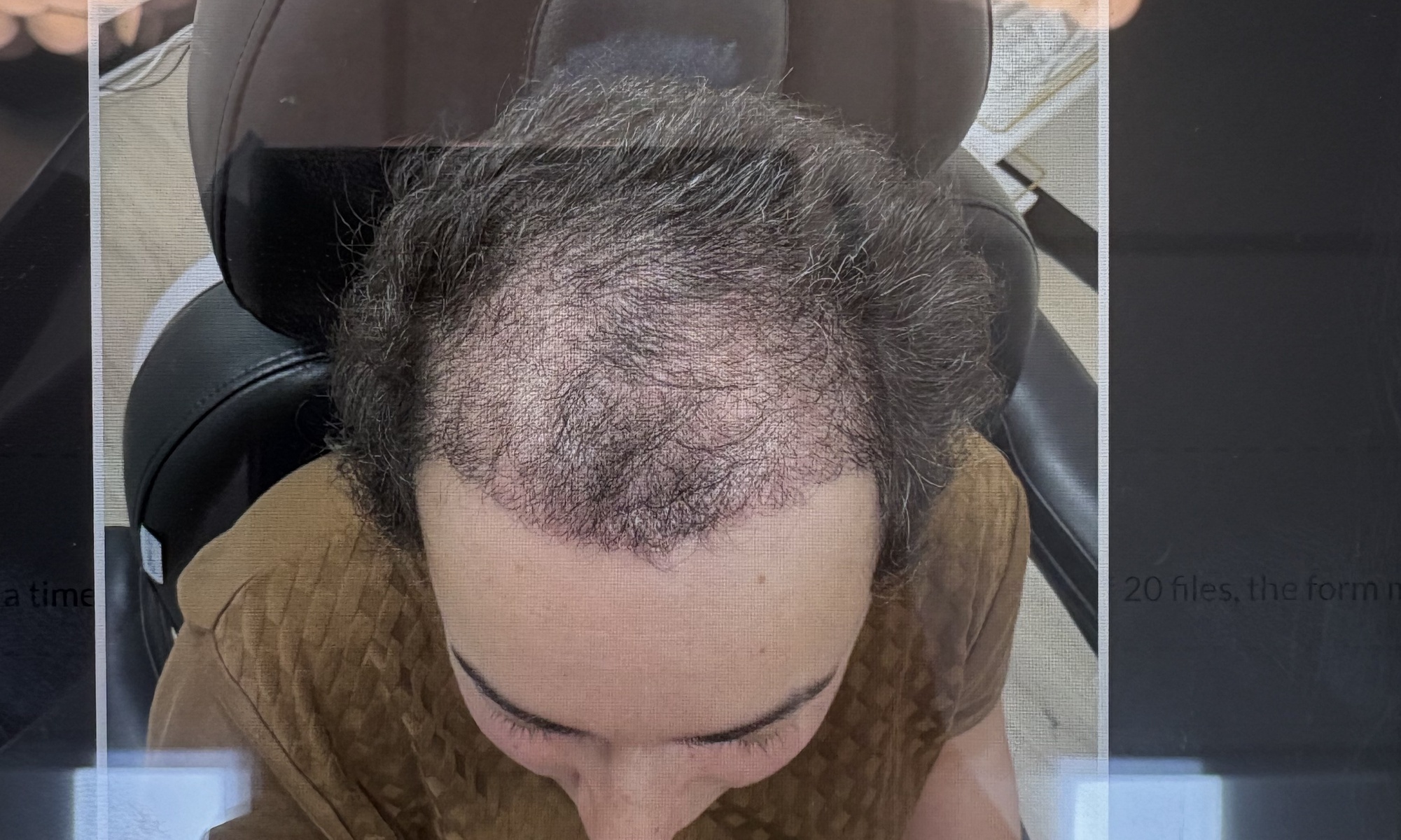 Up to 55% Off on Hair Restoration - Non-Surgical at VC Esthetics