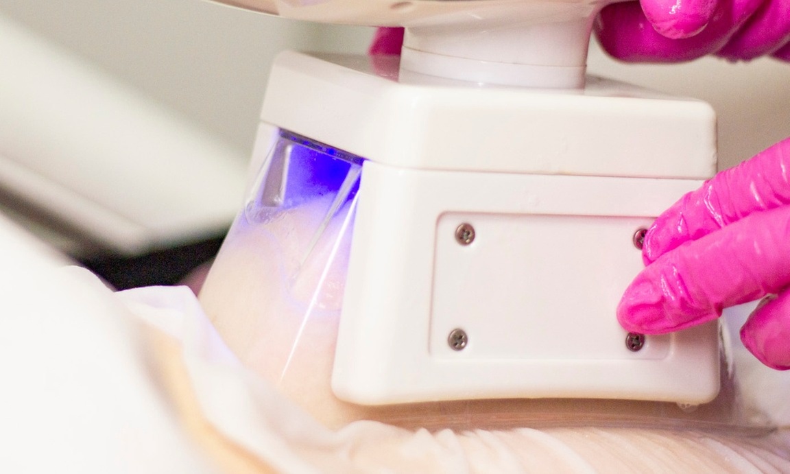 Redukcja tkanki tłuszczowej z kriolipolizą na wybraną partię ciała