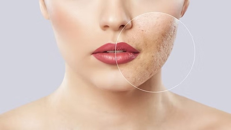 Up to 50% Off on Vampire PRP Facelift at Marjan Spa