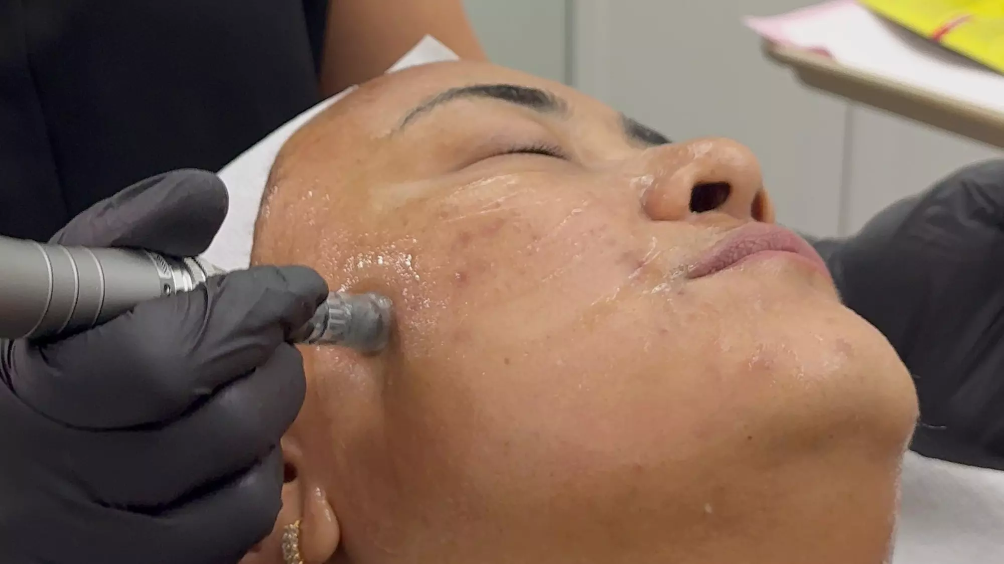 Experience Rejuvenation with One or Three Micro-Needling Treatment