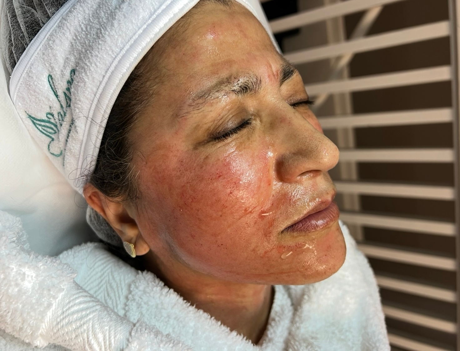 Up to 30% Off on Micro-Needling at Valspa Beauty and Aesthetics